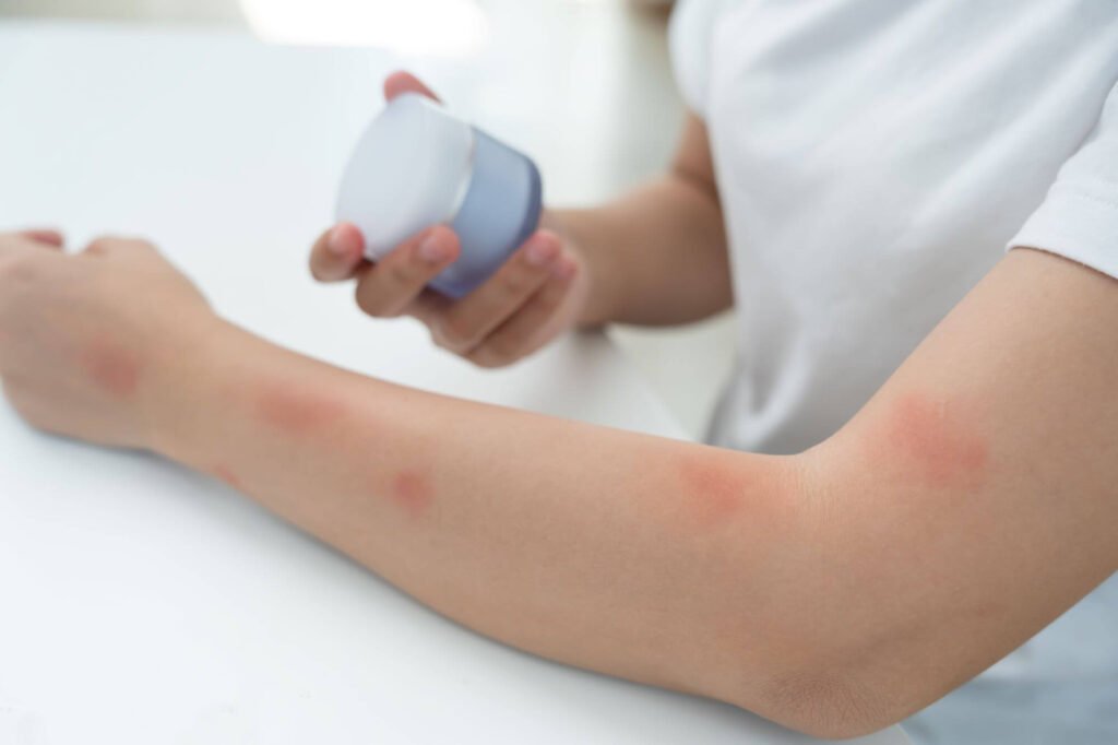 Allergie cutanée à cause d'un produit cosmétique